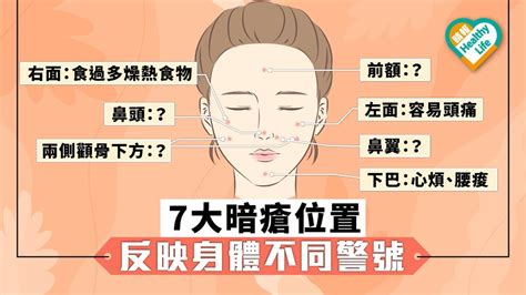 暗瘡 右臉|13個暗瘡位置反映什麽健康狀態？中醫療法 